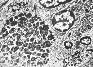 F,68y. | spleen - undefined myelinoid inclusions - clin. susp. leukemia